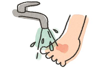 孩子烫伤的紧急处理四大步骤,孩子烫伤“五步”急救法