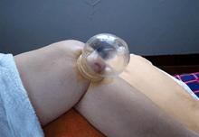 中医拔罐疗法技术,这才是最有效的中医疗法