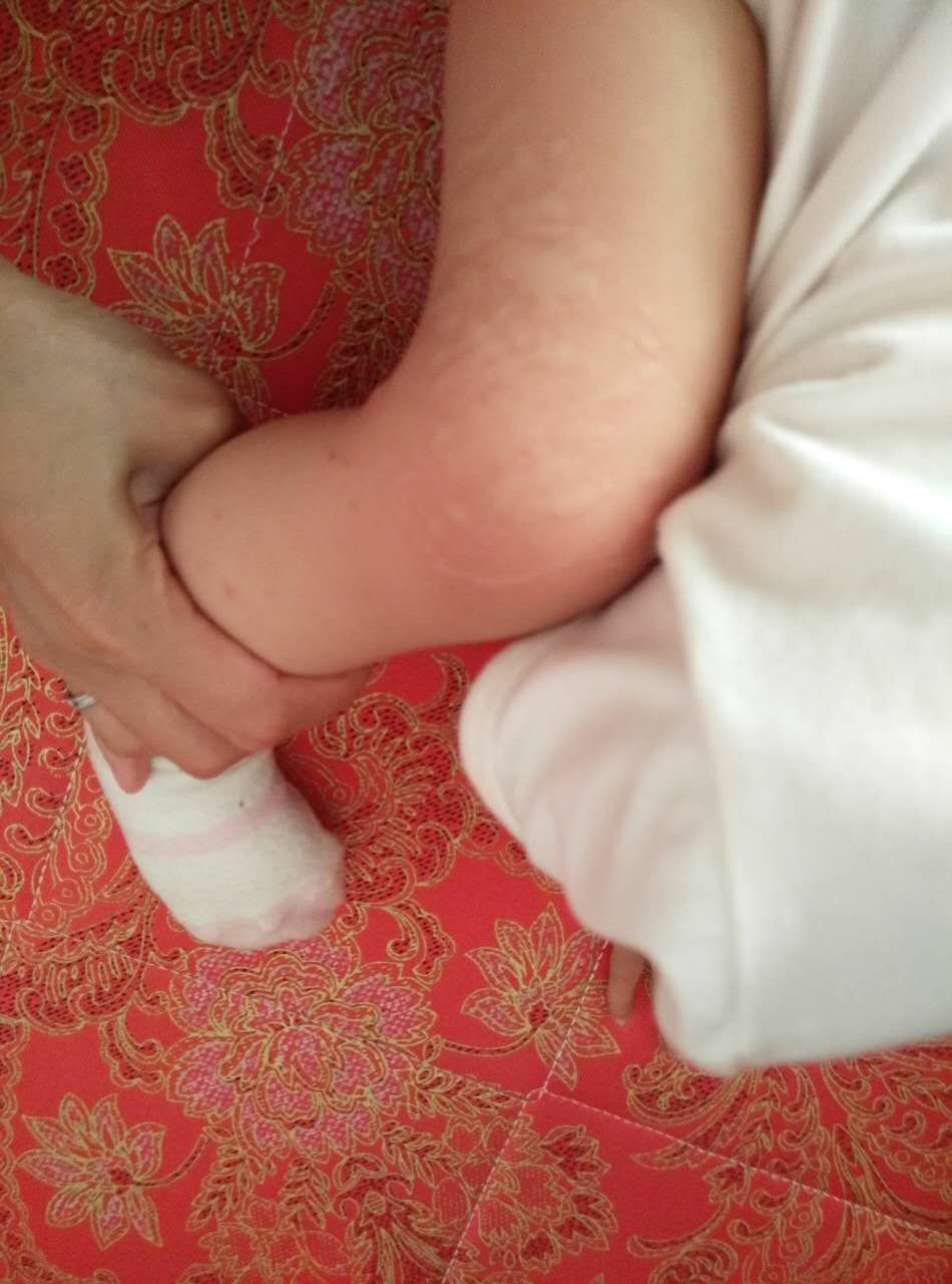 宝宝蚊子咬了起疱疹,小孩蚊虫叮咬后起疱疹是什么原因