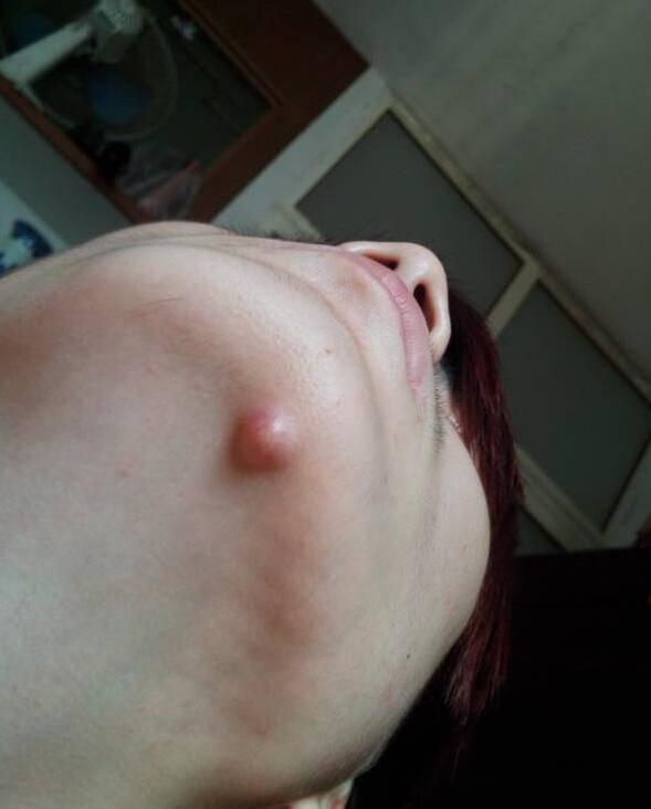 40岁女人下巴长痘痘怎么调理,下巴长痘痘内分泌失调怎么调理