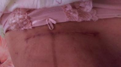 缝合伤口痒是怎么回事,切口愈合后变硬是怎么回事