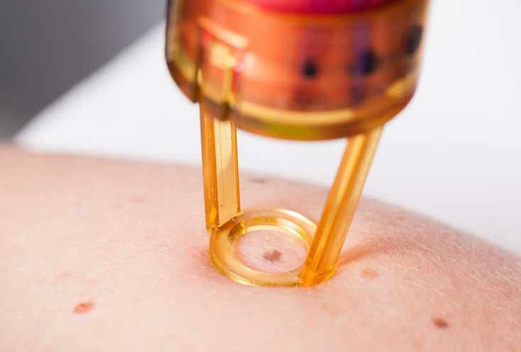 激光点痣三次风险大吗,激光点痣三次了又长出来怎么办