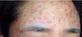 八岁女孩额头上长痘痘什么原因,孕期额头上长痘痘是什么原因