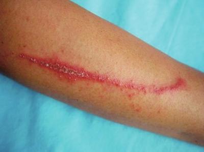 隐翅虫咬后怎么快速恢复,宝宝被隐翅虫咬了怎么办