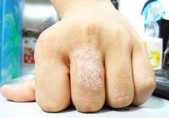 奶癣是吃母乳的原因吗,宝宝得了奶癣会传染的吗