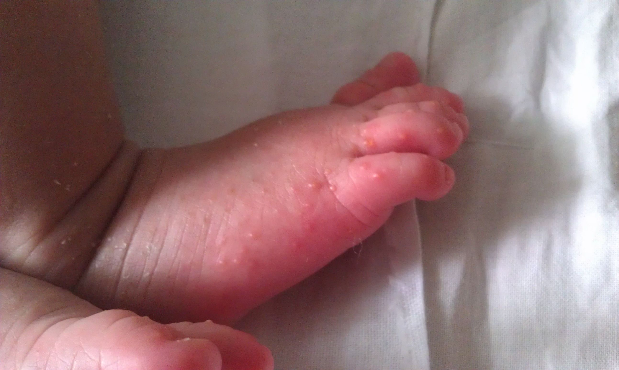 宝宝一热就起湿疹怎么办,宝宝脸上反复湿疹怎么办