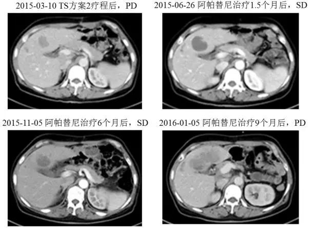 晚期胃癌治疗的思路与误区,晚期胃癌的成功治愈病例