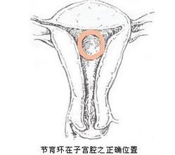 上环所有女性都有副作用,女性上环会引起皮肤差吗