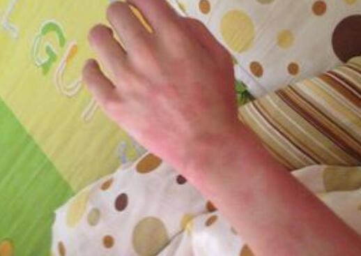 麻疹好了又得了荨麻疹,麻疹需要去医院吗