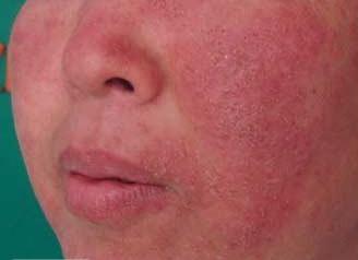 激素皮炎戒断期痒怎么办,激素依赖性皮炎脖子很痒