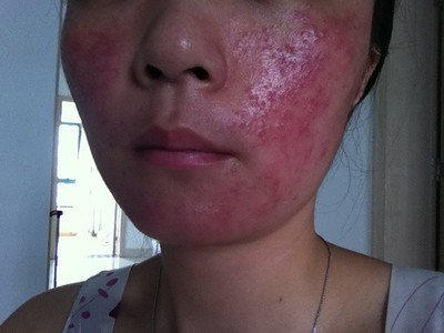 激素皮炎戒断期痒怎么办,激素依赖性皮炎脖子很痒