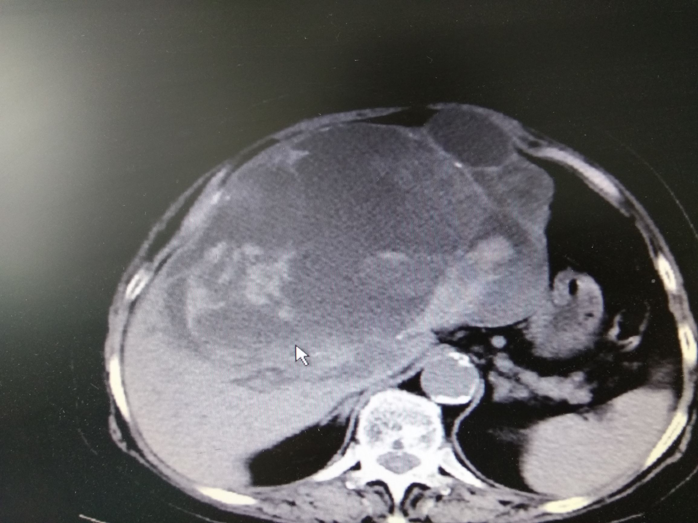 她因为诊断肝囊肿反复穿刺抽液,最后却被证实是癌。