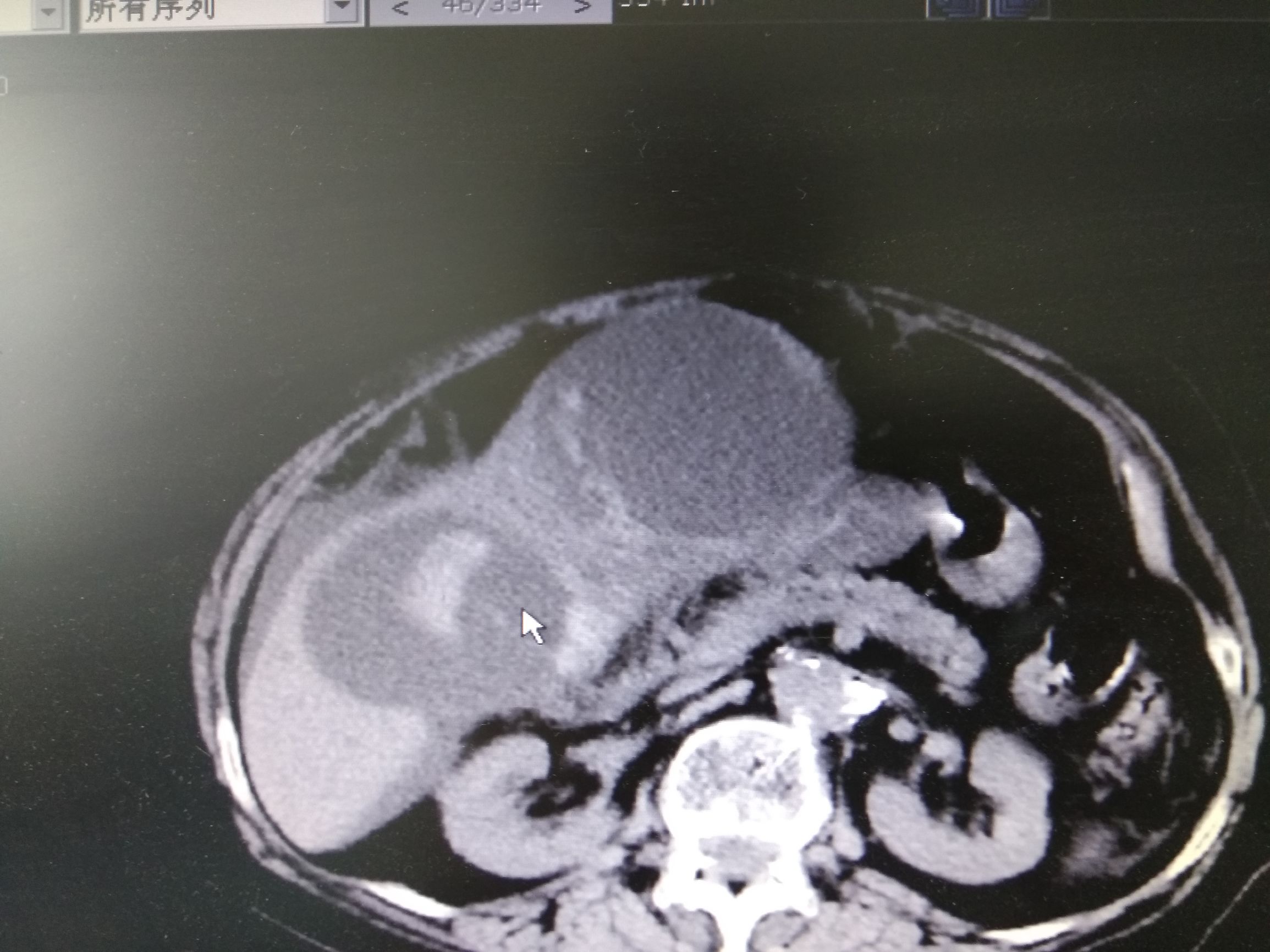 她因为诊断肝囊肿反复穿刺抽液,最后却被证实是癌。