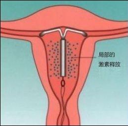 上环所有女性都有副作用,女性上环会引起皮肤差吗