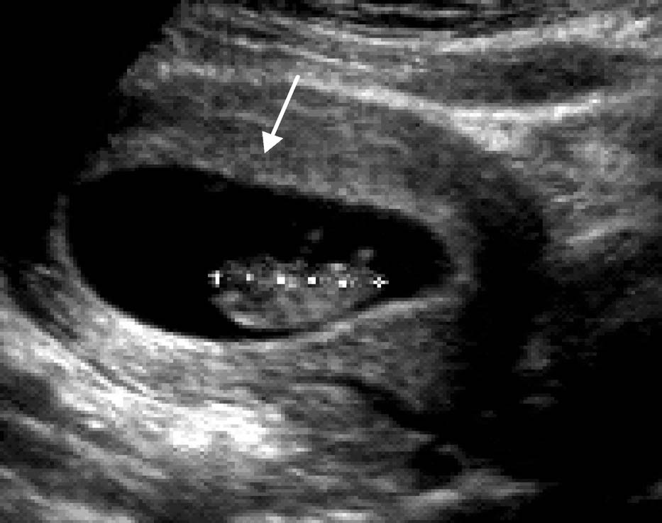 早期妊娠超声主要检查指标视频,输卵管妊娠的超声表现