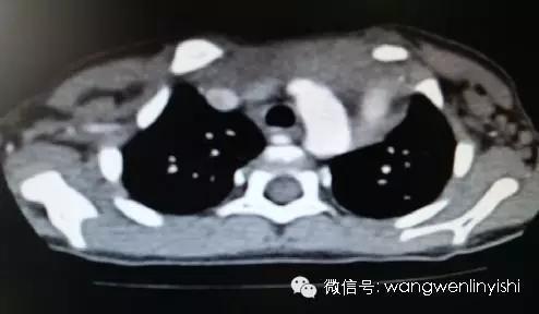 胸骨裂合并先心病的手术治疗