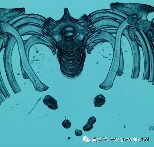 胸骨裂合并先心病的手术治疗