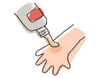 孩子烫伤的紧急处理四大步骤,孩子烫伤“五步”急救法