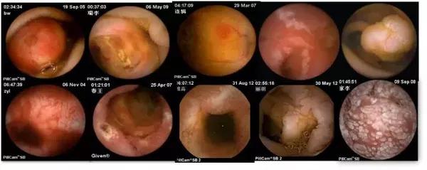 消化道胶囊内镜,胶囊内镜可以看到全部消化道吗