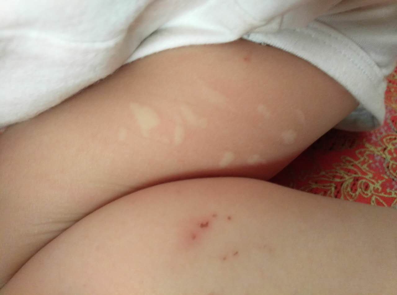 宝宝蚊子咬了起疱疹,小孩蚊虫叮咬后起疱疹是什么原因