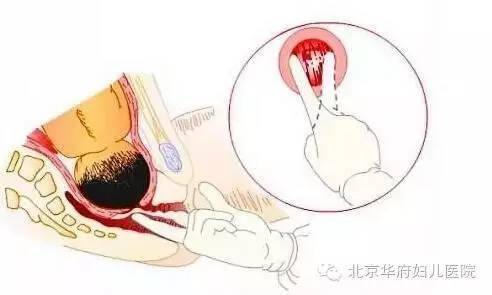 “开十指”是什么意思孕妈们误解了吗?