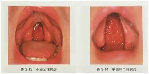 胎儿唇腭裂的原因,唇腭裂影响说话吗