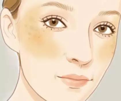 容易长斑的人是什么体质,最易长斑的5个时期