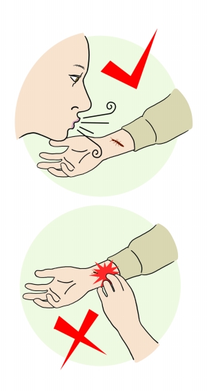 隐翅虫咬后怎么快速恢复,宝宝被隐翅虫咬了怎么办