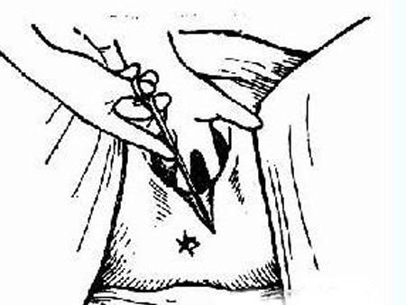 会阴侧切到底好不好？让人纠结的那一刀！