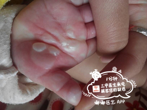 孩子烫伤妈妈不停的自责,家庭必备宝宝烫伤的紧急处理办法