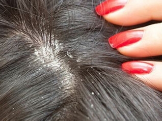 如果你的头上有很多头皮屑怎么办,头上有那么多的头皮屑为什么呢