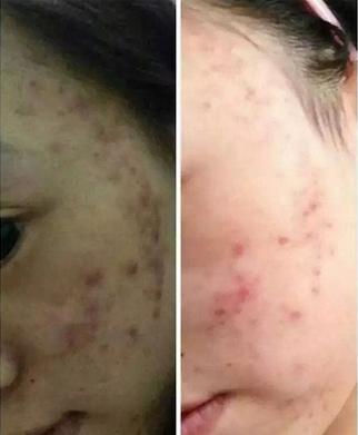 祛痘妙招生理期痘痘治疗方法