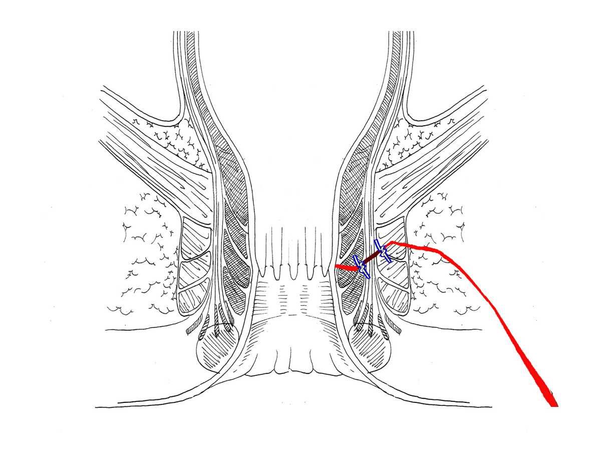 肛瘘如何克服手术前的恐惧,肛瘘复发有征兆怎样补救