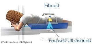 做了子宫肌瘤手术要多久可以备孕,专家解答子宫肌瘤