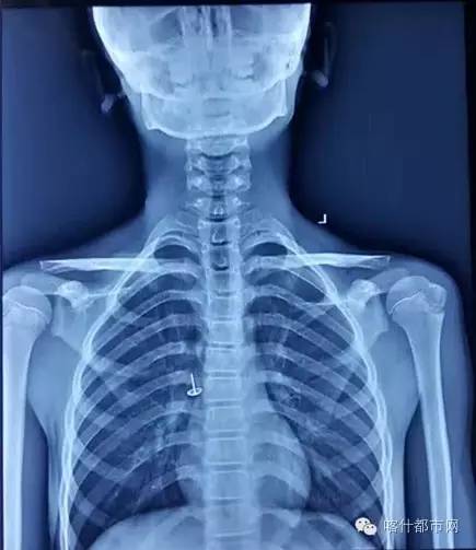 男孩误吞图钉,男孩吞下一枚图钉