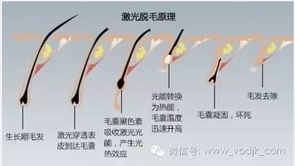 激光脱毛是永久的吗,激光脱毛仪真的可以永久脱毛吗