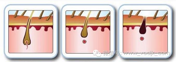 激光脱毛是永久的吗,激光脱毛仪真的可以永久脱毛吗