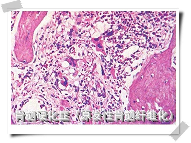 白血病治疗期间血小板升高,白血病血小板有什么用