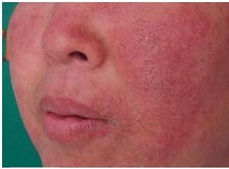 根治红血丝最好的方法,红血丝祛除最有效方法有哪些