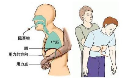 小孩喉咙卡住海姆立克急救法教学,小孩异物卡喉海姆立克急救法