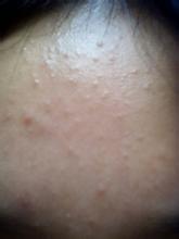 痘痘肌怎么去粉刺闭口,痘痘肌怎么去螨虫