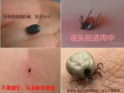 霍山被蜱虫咬了21天发烧了怎么办,警惕这种虫有人被咬后差点没命