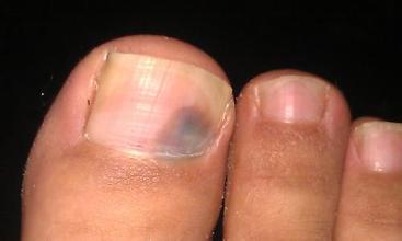 灰指甲一定要尽早正确治疗,灰指甲治疗过程会疼吗