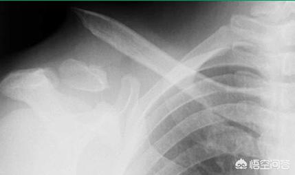 小孩子骨折不可以用药吗,小孩有点骨折不打石膏可以吗