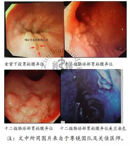 食管胃粘膜异位症,先天性胃粘膜异位