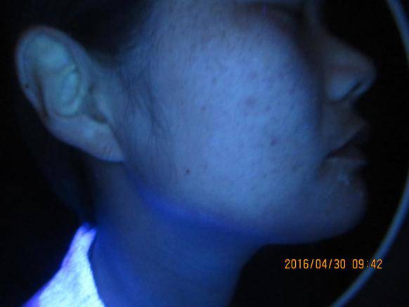 惊！准新娘美好婚姻突遭变故，越挫越勇战胜白癜风