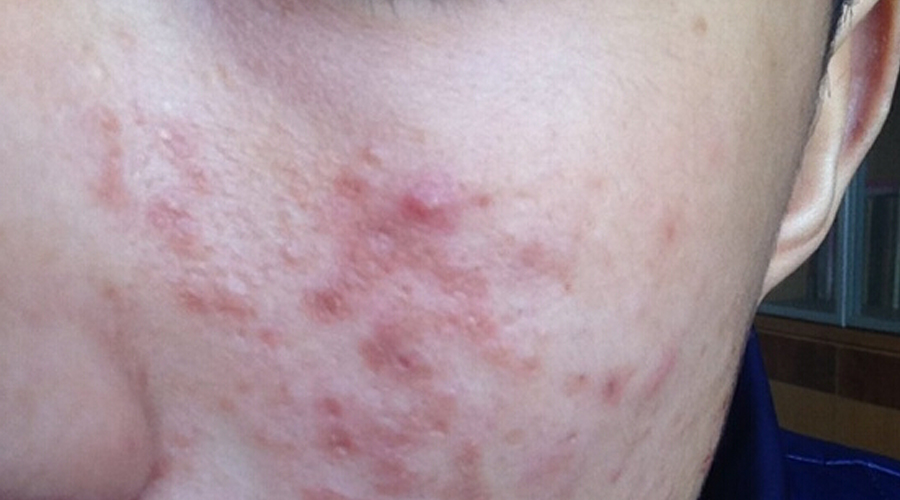 皮炎夏季又红又热,夏季皮炎怎么预防和治疗