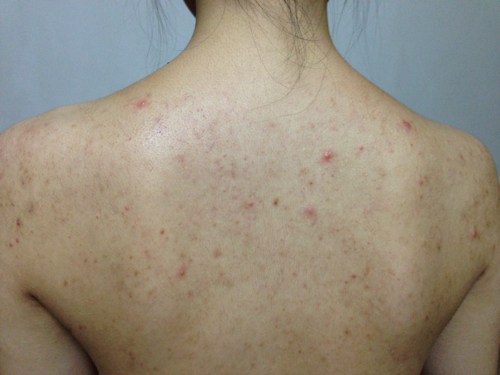 脸蛋上长痘痘的原因和解决方法,脸蛋长痘痘是什么原因怎么调理