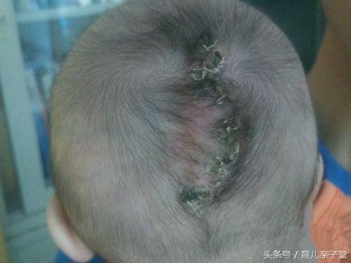 初生女婴头上长肉瘤,四月时长有两“脑袋”!