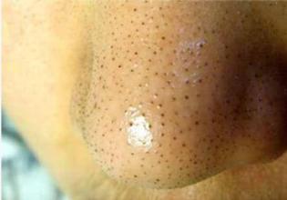 去黑头需谨慎极度后悔,正确去黑头有5个步骤